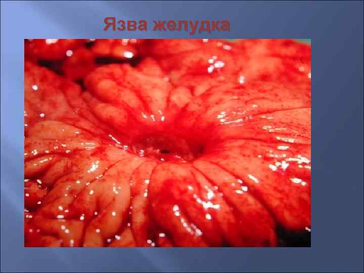 Язва желудка 