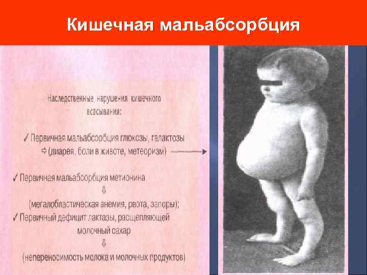 Кишечная мальабсорбция 