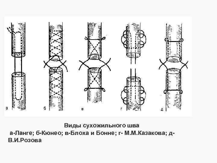 Виды сухожильного шва а-Ланге; б-Кюнео; в-Блоха и Бонне; г- М. М. Казакова; д. В.