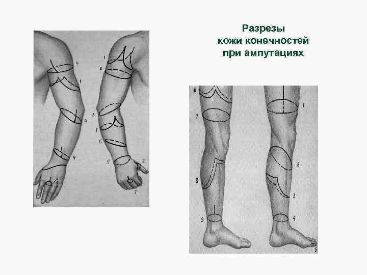 Травматическая ампутация голени карта вызова