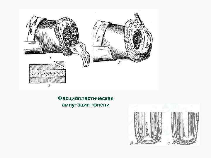 Фасциопластическая ампутация голени 