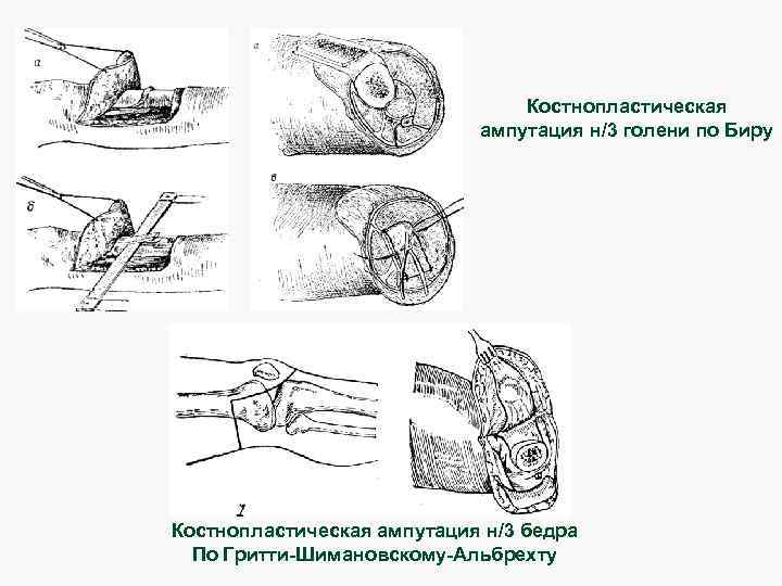 Костнопластическая ампутация н/3 голени по Биру Костнопластическая ампутация н/3 бедра По Гритти-Шимановскому-Альбрехту 