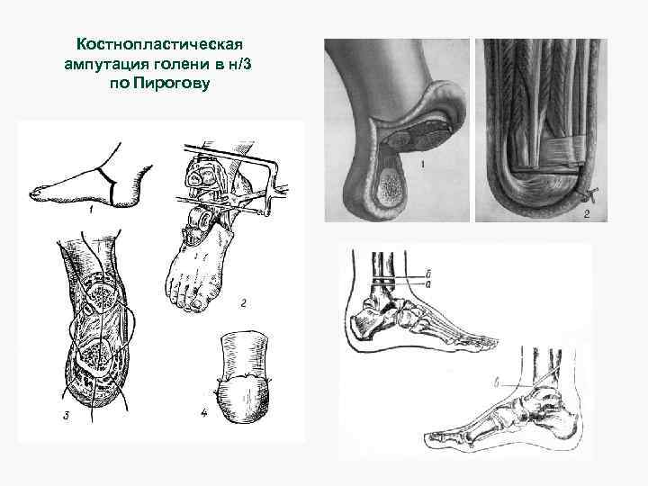 Костнопластическая ампутация голени в н/3 по Пирогову 