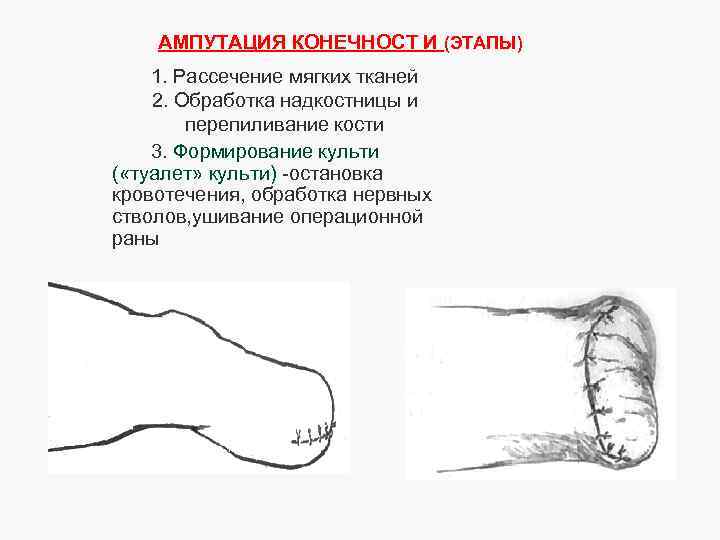 АМПУТАЦИЯ КОНЕЧНОСТ И (ЭТАПЫ) 1. Рассечение мягких тканей 2. Обработка надкостницы и перепиливание кости