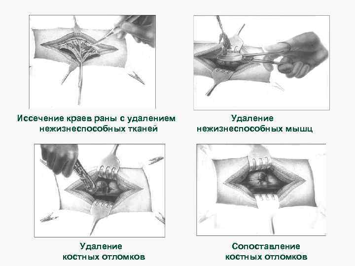 Иссечение краев раны с удалением нежизнеспособных тканей Удаление костных отломков Удаление нежизнеспособных мышц Сопоставление