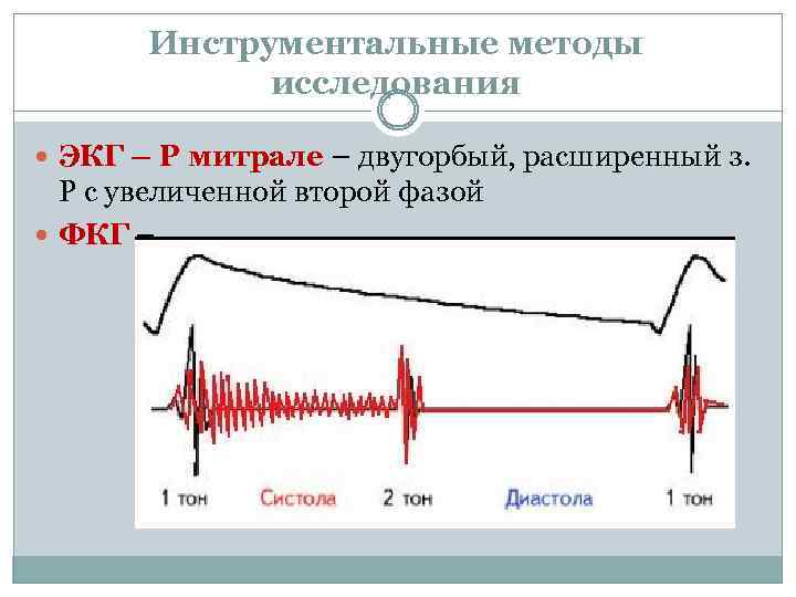 Инструментальные методы исследования ЭКГ – Р митрале – двугорбый, расширенный з. Р с увеличенной