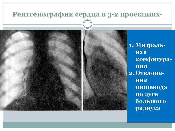 Рентгенография сердца в 3 -х проекциях- 1. Митральная конфигурация 2. Отклонение пищевода по дуге