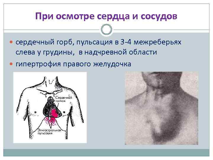 При осмотре сердца и сосудов сердечный горб, пульсация в 3 -4 межреберьях слева у