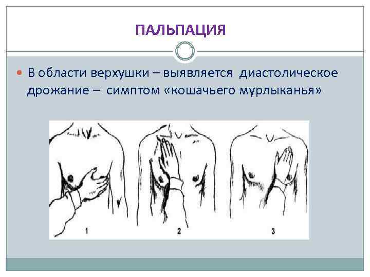 ПАЛЬПАЦИЯ В области верхушки – выявляется диастолическое дрожание – симптом «кошачьего мурлыканья» 