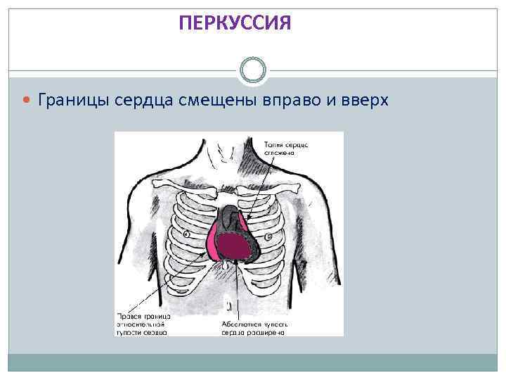 ПЕРКУССИЯ Границы сердца смещены вправо и вверх 