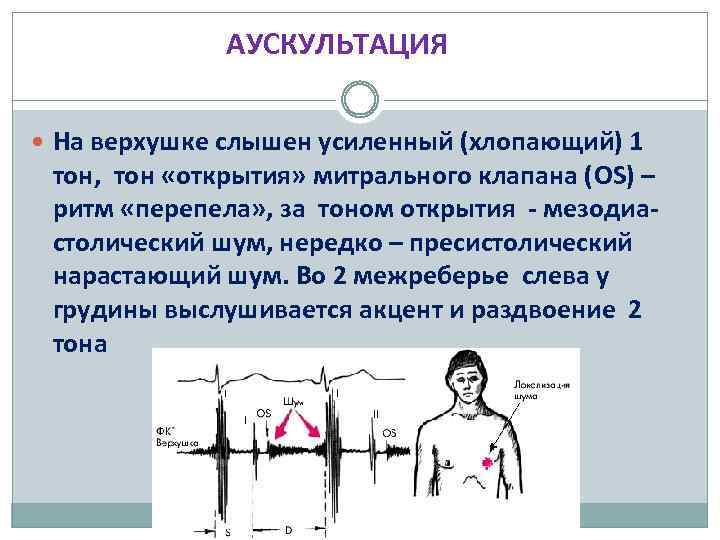 АУСКУЛЬТАЦИЯ На верхушке слышен усиленный (хлопающий) 1 тон, тон «открытия» митрального клапана (OS) –