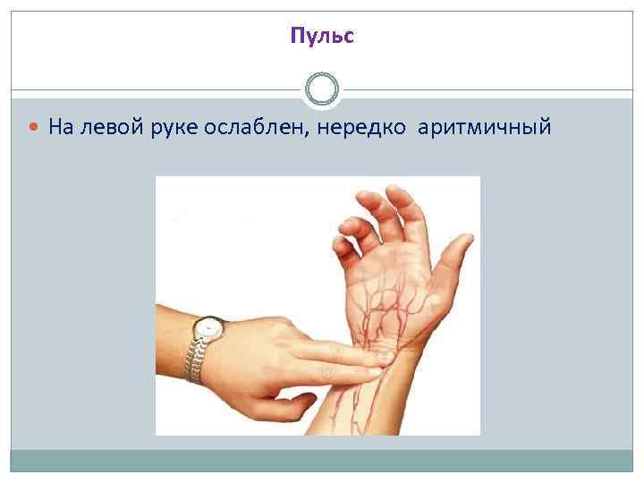Пульс На левой руке ослаблен, нередко аритмичный 