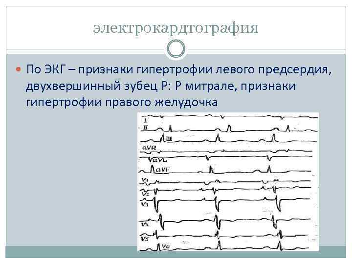 электрокардтография По ЭКГ – признаки гипертрофии левого предсердия, двухвершинный зубец Р: Р митрале, признаки
