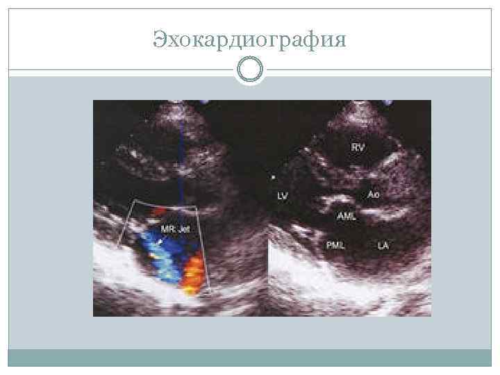 Эхокардиография 