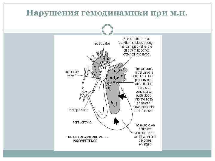 Нарушения гемодинамики при м. н. 