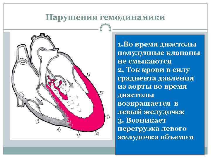 Нарушения гемодинамики 1. Во время диастолы полулунные клапаны не смыкаются 2. Ток крови в