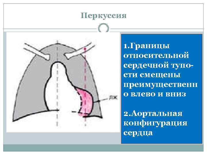 Перкуссия 1. Границы относительной сердечной тупости смещены преимущественн о влево и вниз 2. Аортальная