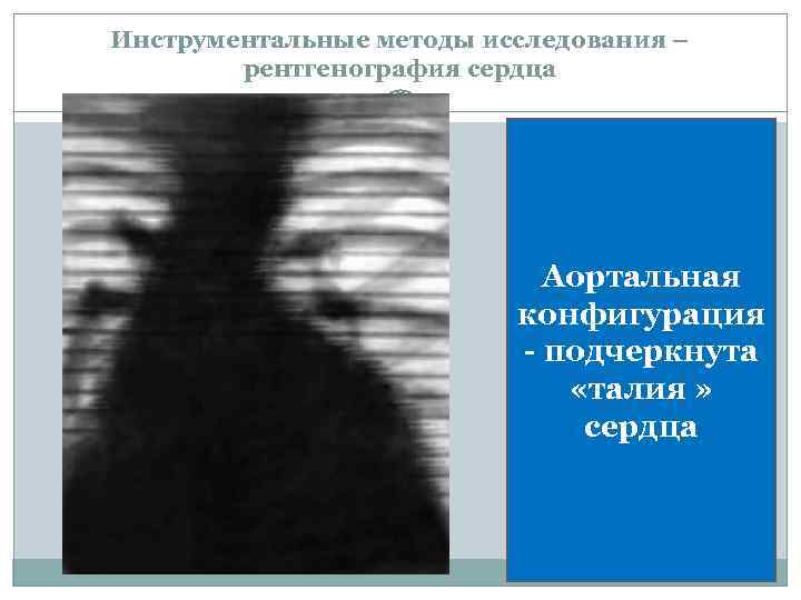 Инструментальные методы исследования – рентгенография сердца Аортальная конфигурация - подчеркнута «талия » сердца 