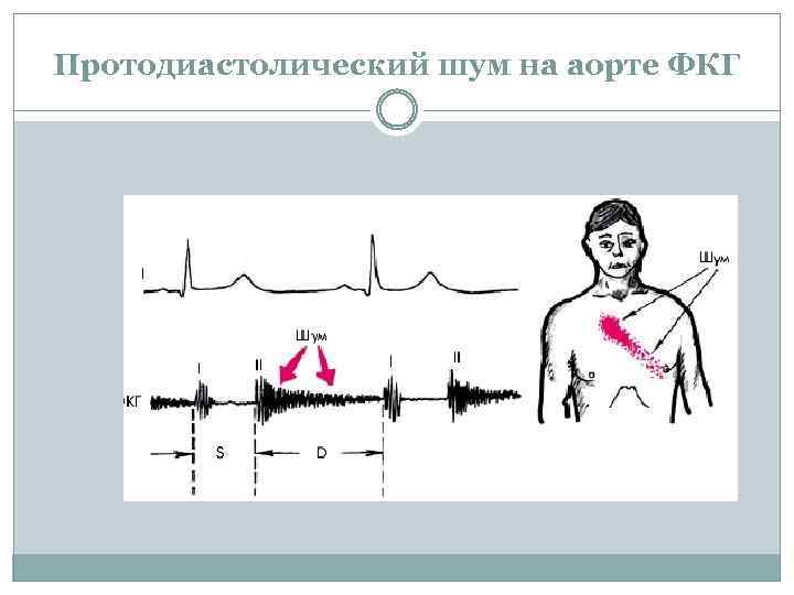 Протодиастолический шум на аорте ФКГ 