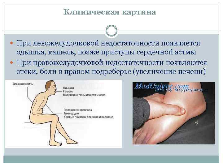 Клиническая картина При левожелудочковой недостаточности появляется одышка, кашель, позже приступы сердечной астмы При правожелудочковой