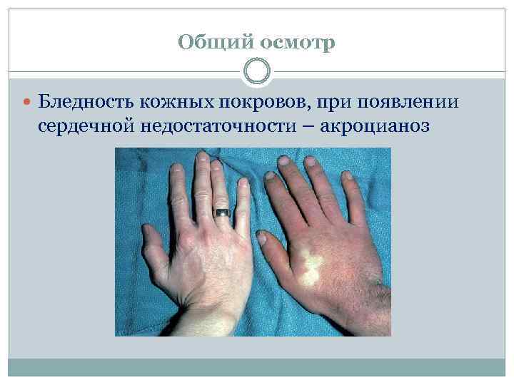Общий осмотр Бледность кожных покровов, при появлении сердечной недостаточности – акроцианоз 