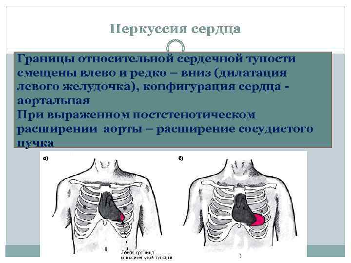 Перкуссия сердца Границы относительной сердечной тупости смещены влево и редко – вниз (дилатация левого