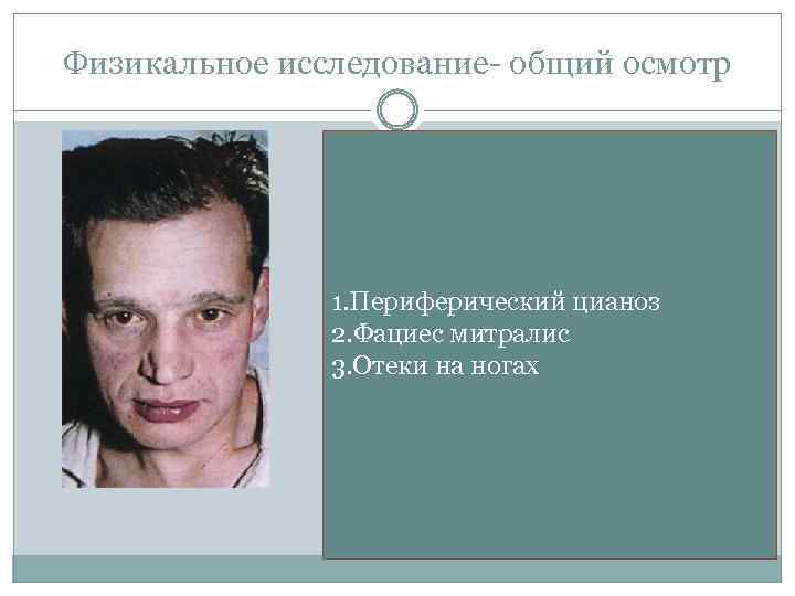 Физикальное исследование- общий осмотр 1. Периферический цианоз 2. Фациес митралис 3. Отеки на ногах