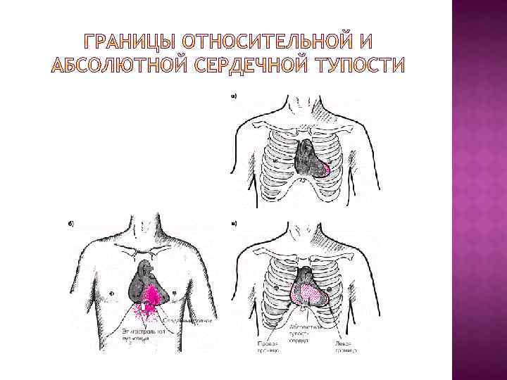 Верхняя граница относительной сердечной. Границы относительной тупости сердца в норме. Границы относительной и абсолютной сердечной тупости.