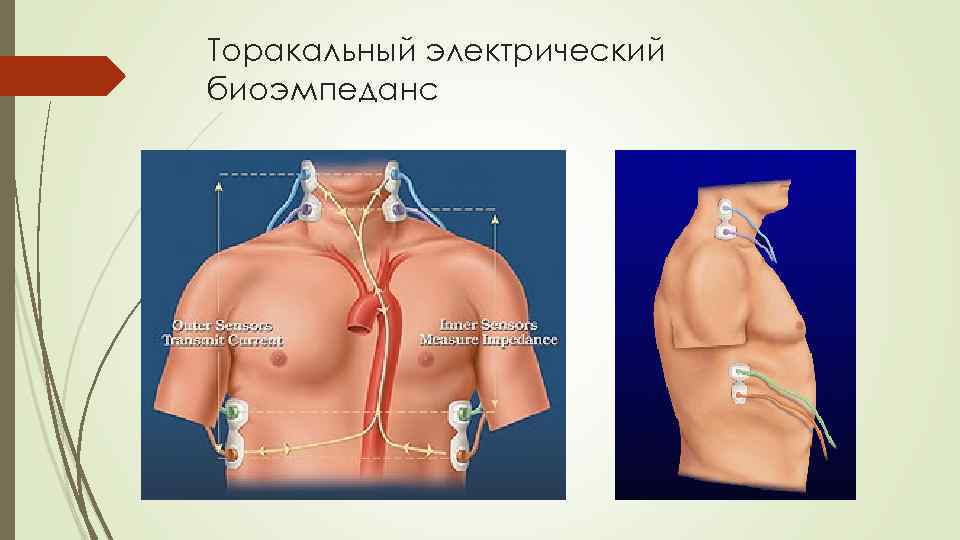 Торакальный электрический биоэмпеданс 