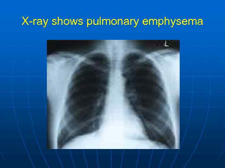 X-ray shows pulmonary emphysema 