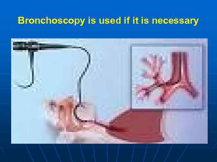 Bronchoscopy is used if it is necessary 