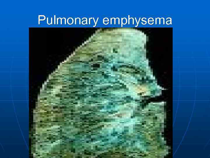 Pulmonary emphysema 