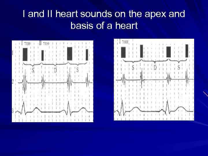 I and II heart sounds on the apex and basis of a heart 