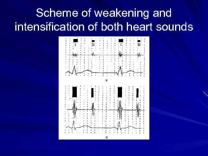 Scheme of weakening and intensification of both heart sounds 