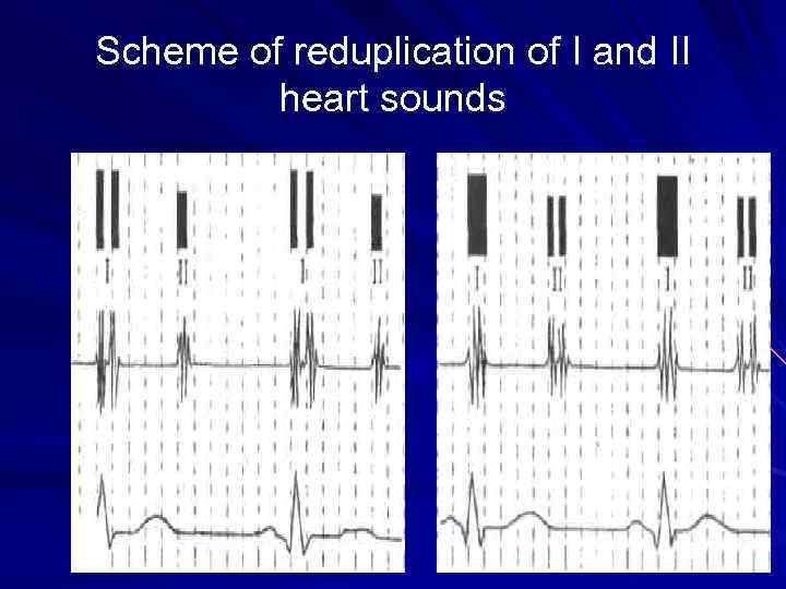 Scheme of reduplication of I and II heart sounds 