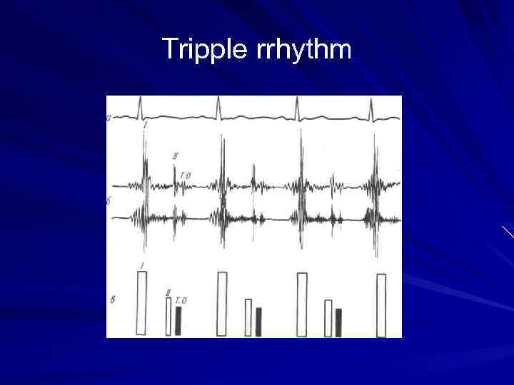 Tripple rrhythm 