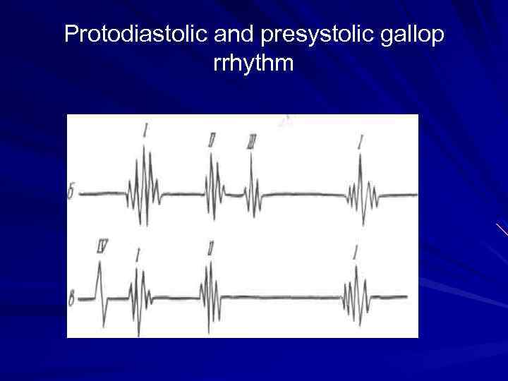 Protodiastolic and presystolic gallop rrhythm 