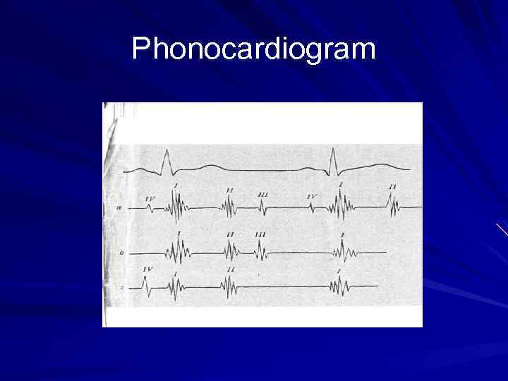 Phonocardiogram 