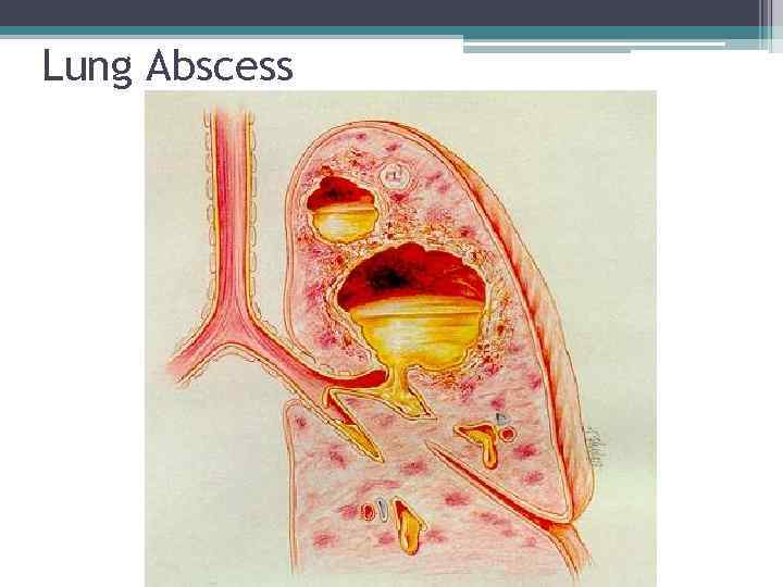 Lung Abscess 