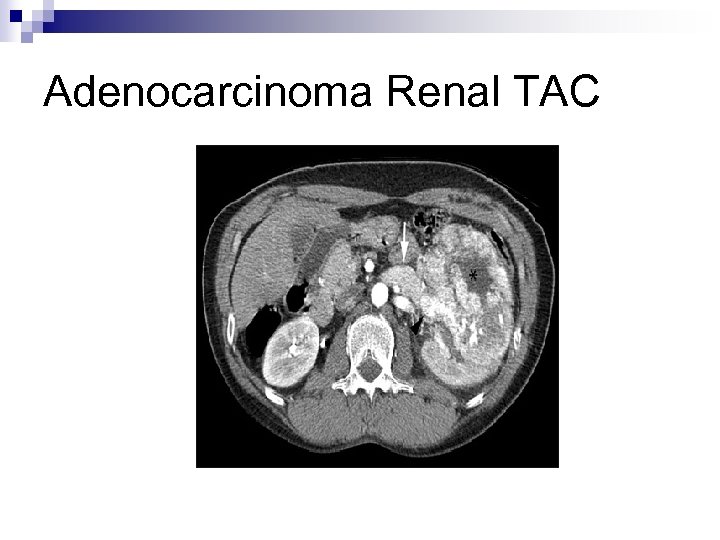 Adenocarcinoma Renal TAC 