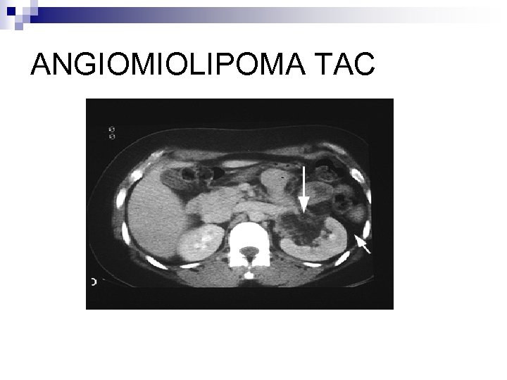 ANGIOMIOLIPOMA TAC 