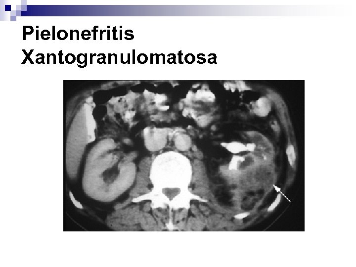 Pielonefritis Xantogranulomatosa 