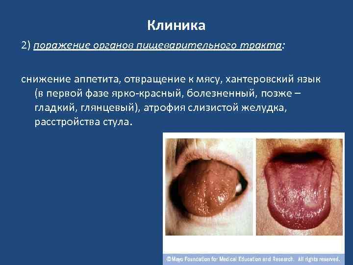 Клиника 2) поражение органов пищеварительного тракта: снижение аппетита, отвращение к мясу, хантеровский язык (в
