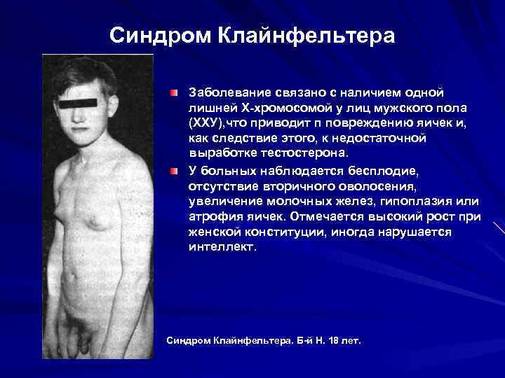 Синдром Клайнфельтера Заболевание связано с наличием одной лишней Х-хромосомой у лиц мужского пола (ХХУ),