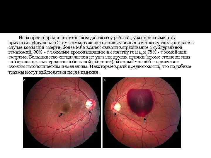 На вопрос о предположительном диагнозе у ребенка, у которого имеются признаки субдуральной гематомы, тяжелого