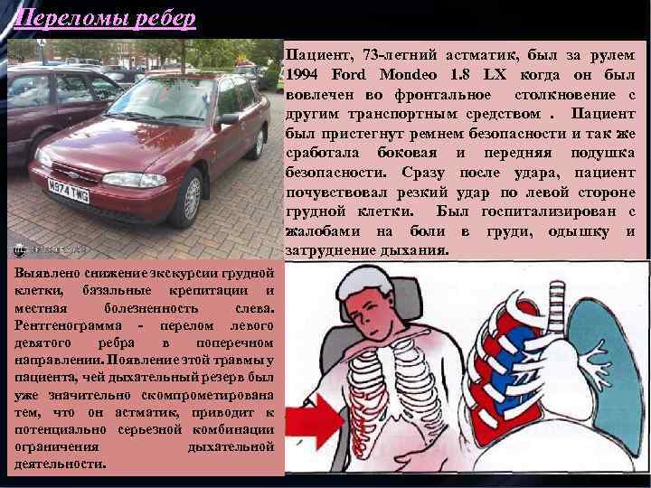 Переломы ребер Пациент, 73 -летний астматик, был за рулем 1994 Ford Mondeo 1. 8