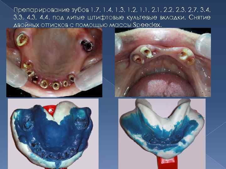 Препарирование зубов 1. 7, 1. 4, 1. 3, 1. 2, 1. 1, 2. 2,