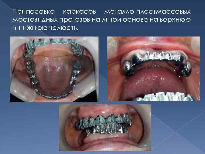 Припасовка каркасов металло-пластмассовых мостовидных протезов на литой основе на верхнюю и нижнюю челюсть. 