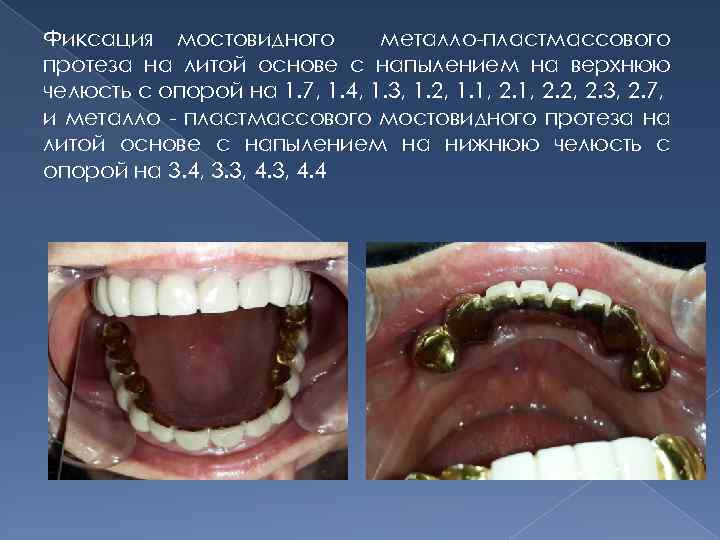 Фиксация мостовидного металло-пластмассового протеза на литой основе с напылением на верхнюю челюсть с опорой