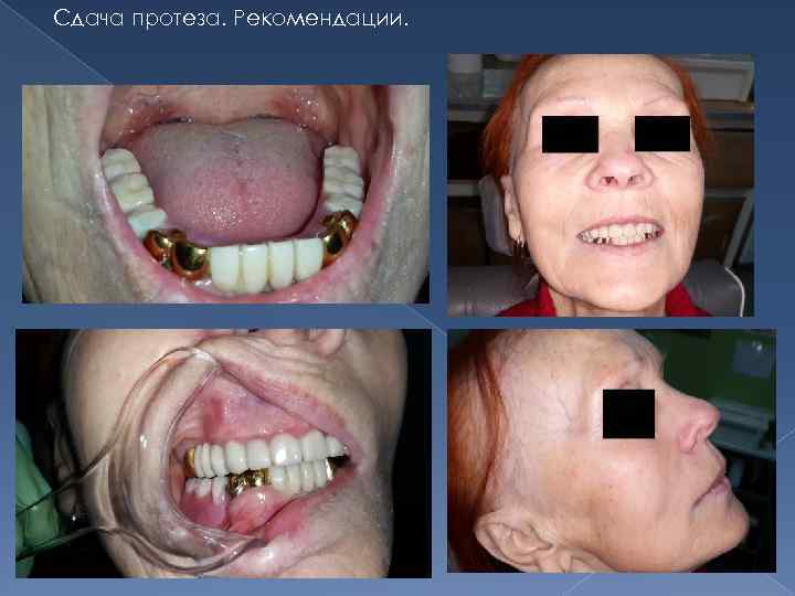 Сдача протеза. Рекомендации. 
